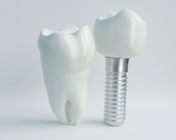 インプラントによる歯科治療