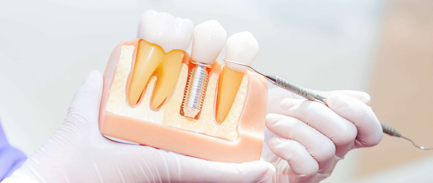 インプラントによる歯科治療とは
